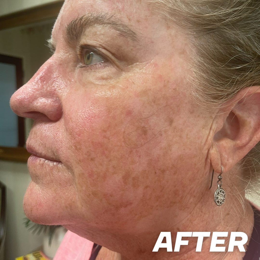 Gail after treatment