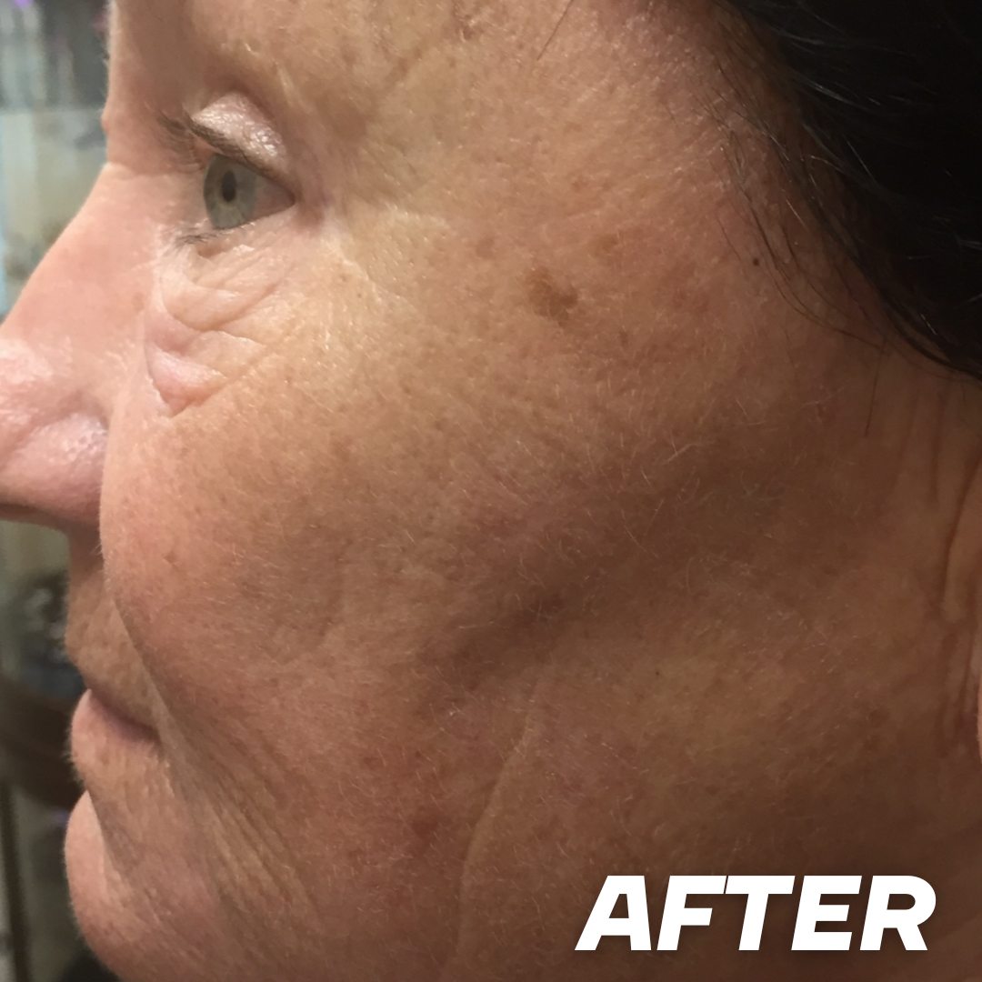 Joanne after treatment