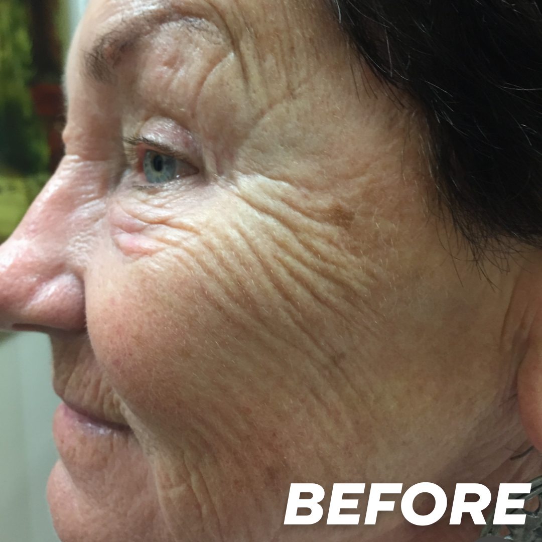 Joanne before treatment