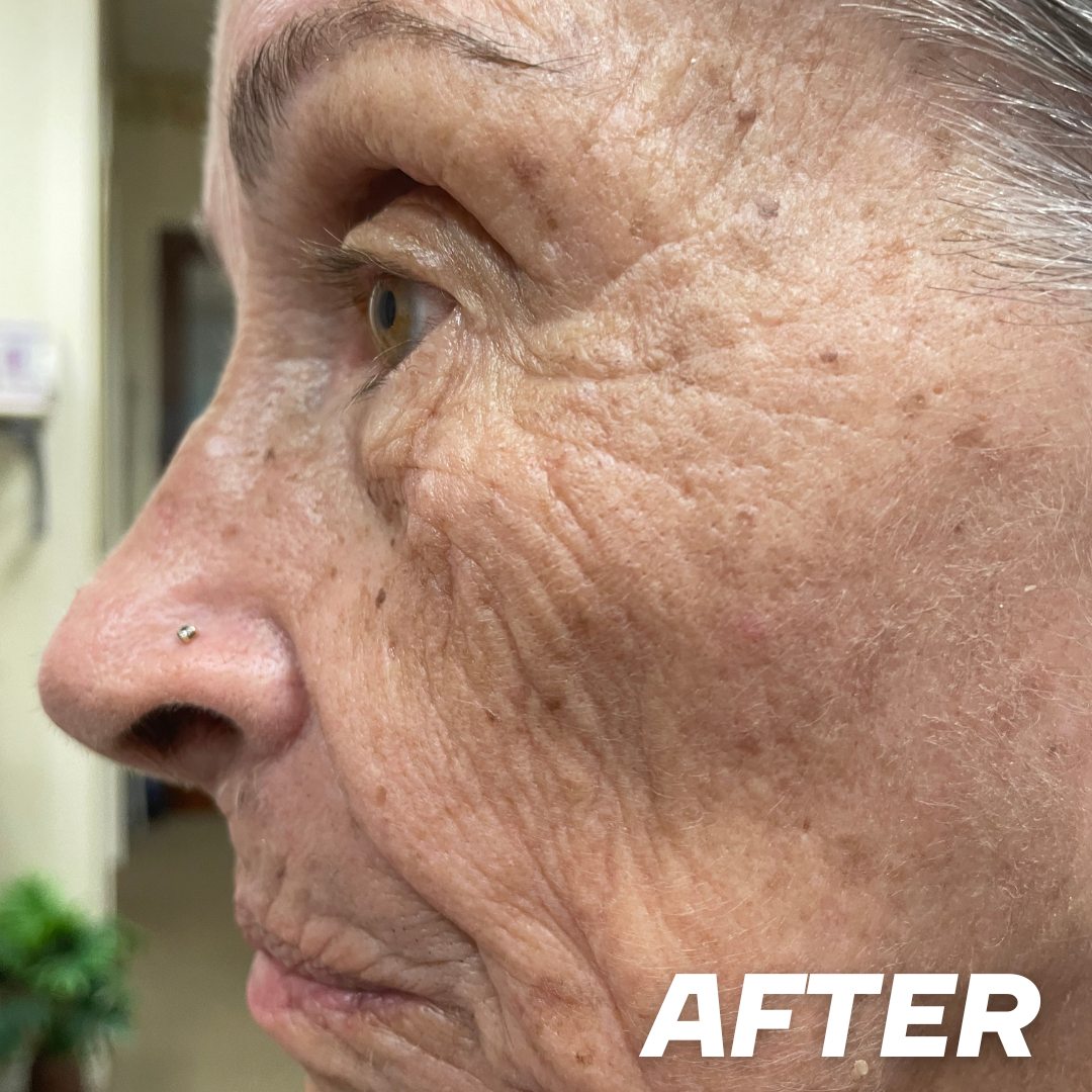 Becky 1 after treatment