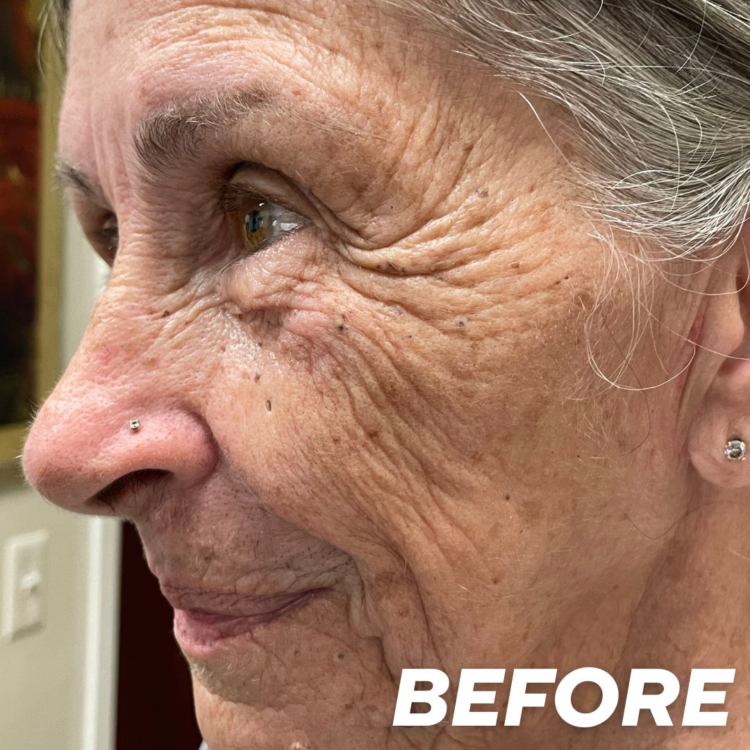 Becky 1 before treatment