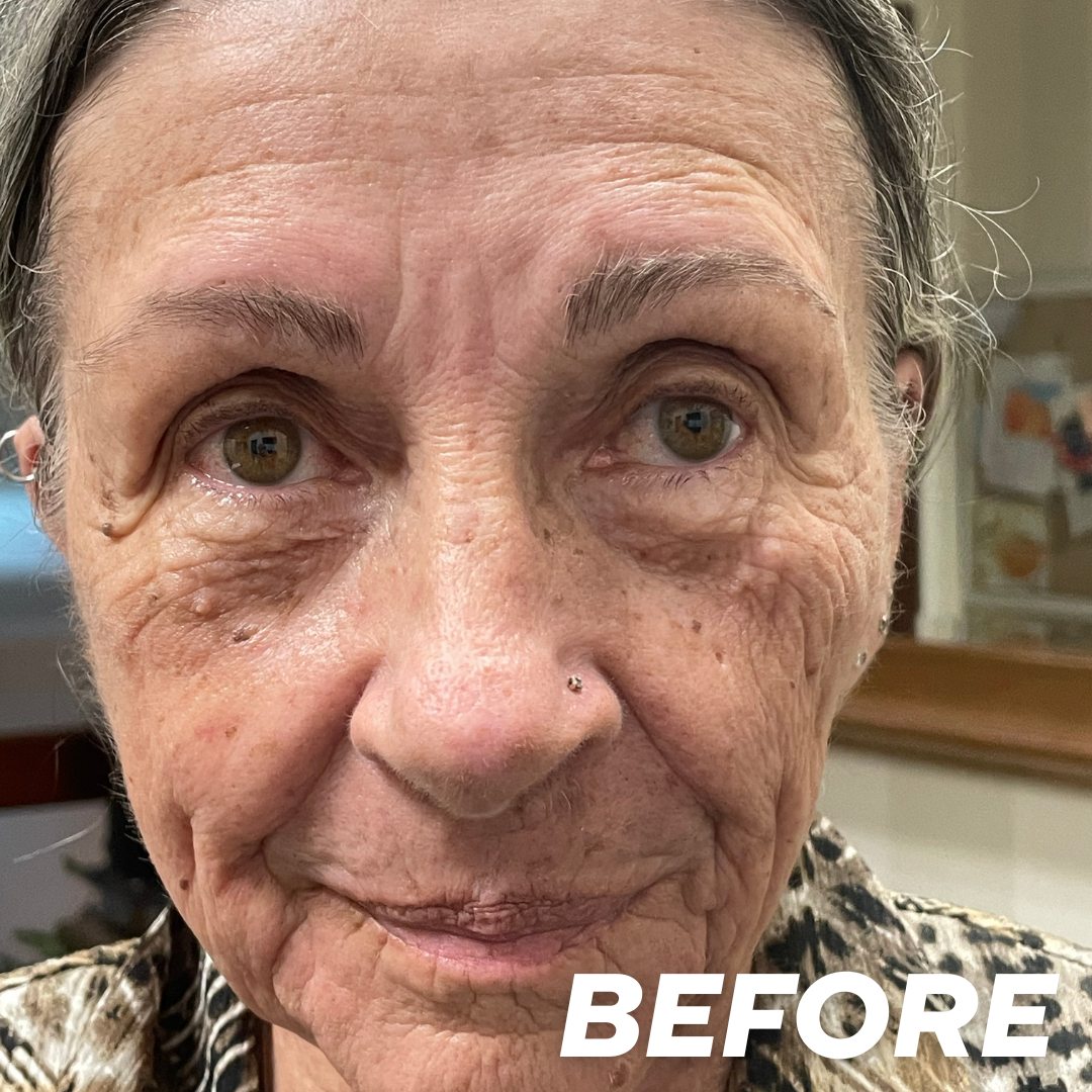 Becky 1 V2 before treatment