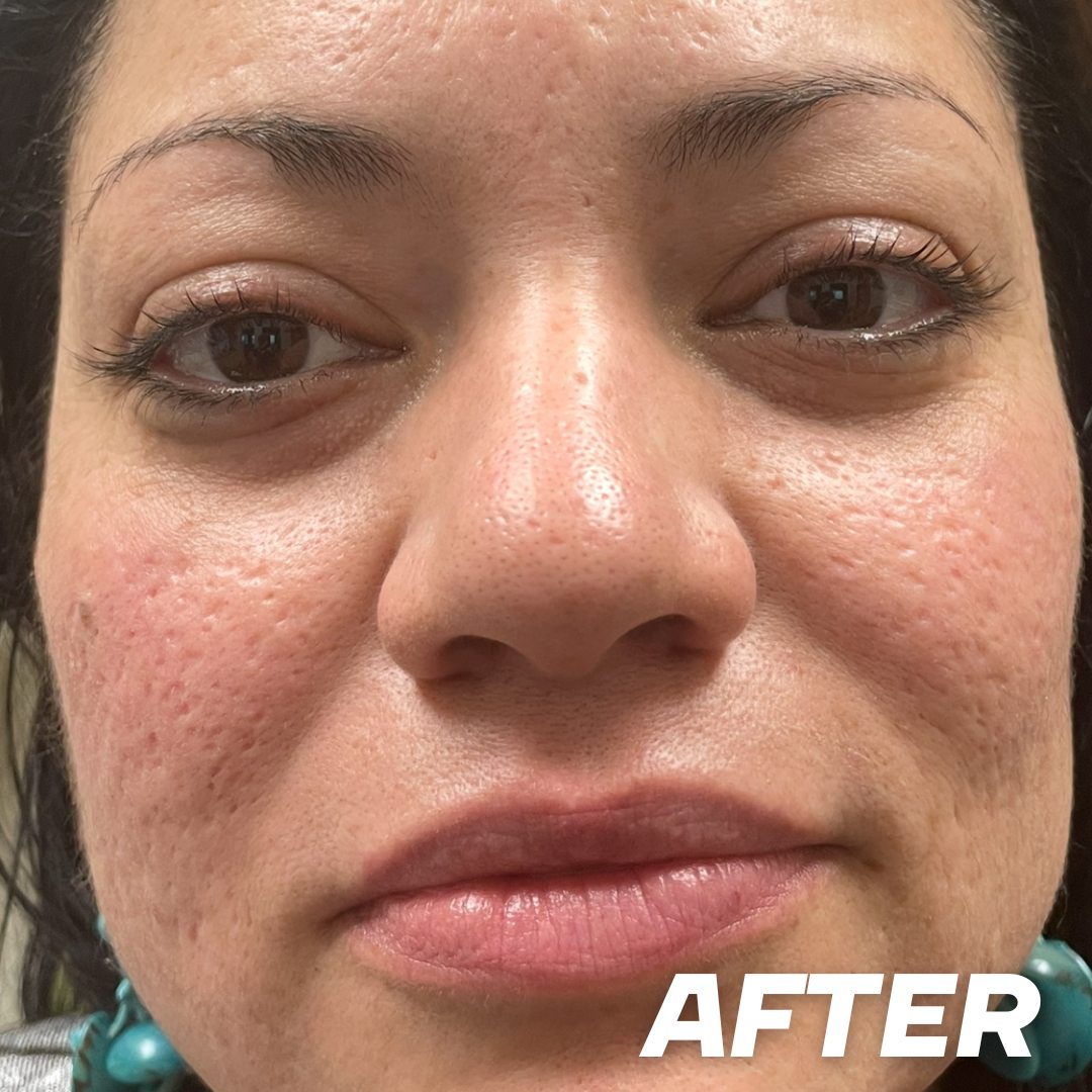 Becky after treatment