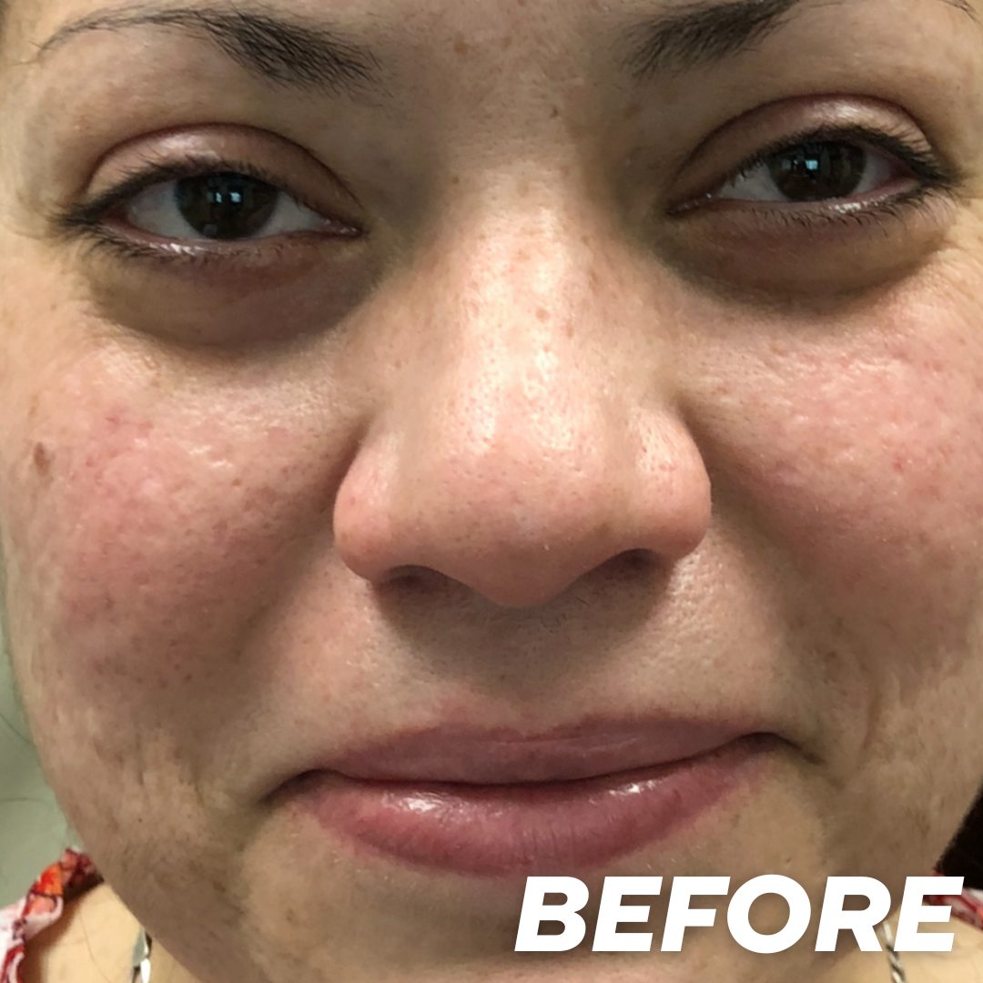 Becky before treatment