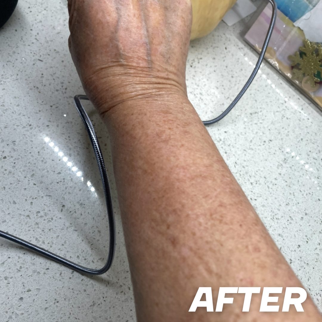 Deb after treatment