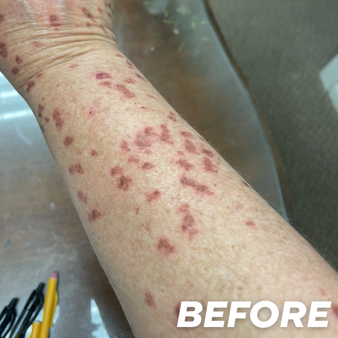 Deb before treatment