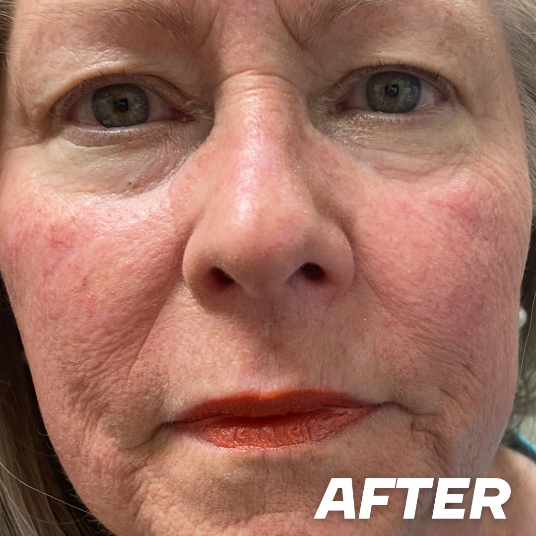 Diane after treatment