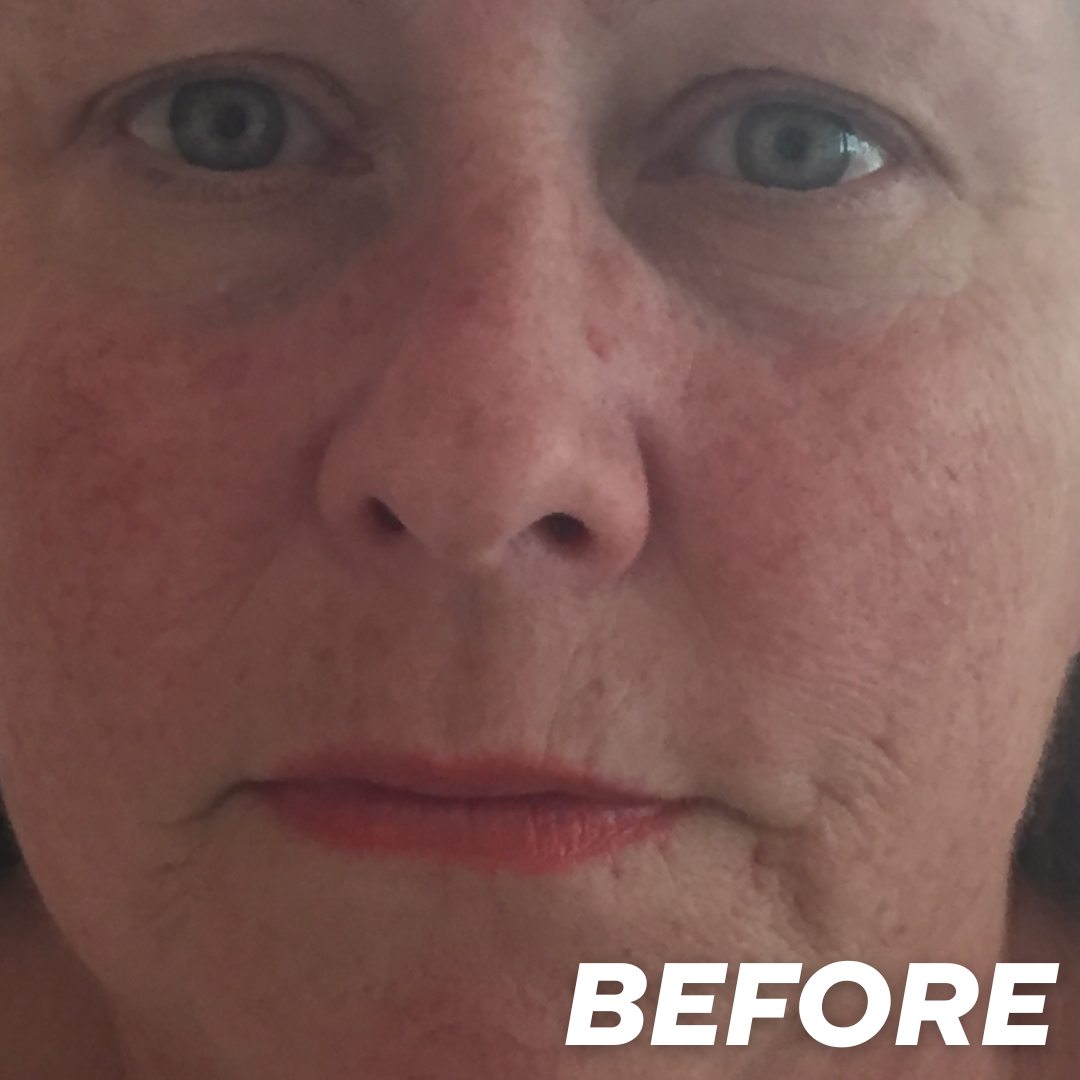 Diane before treatment