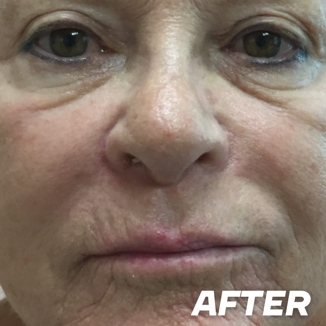 J after treatment