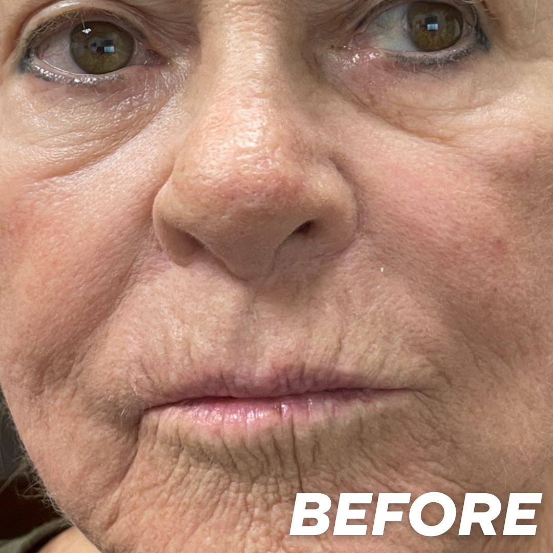 J before treatment