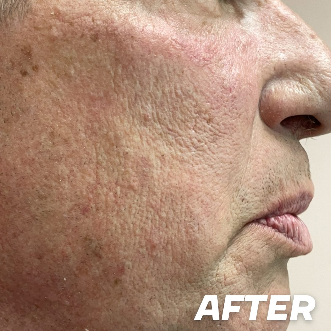 Jeff after treatment