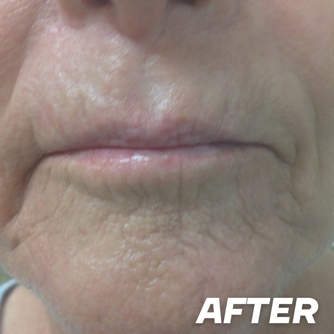 Joan 1 after treatment