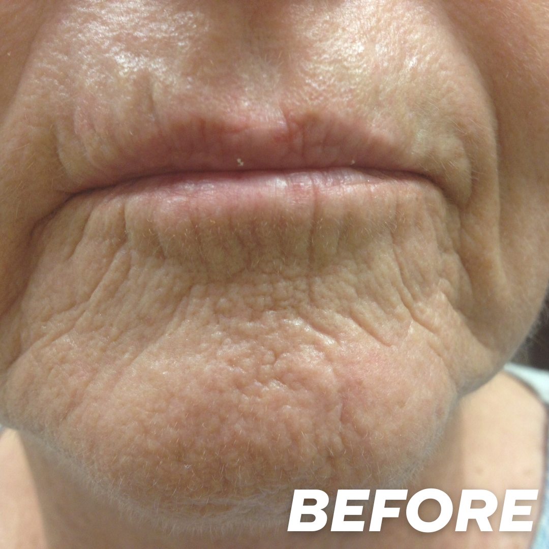 Joan 1 before treatment
