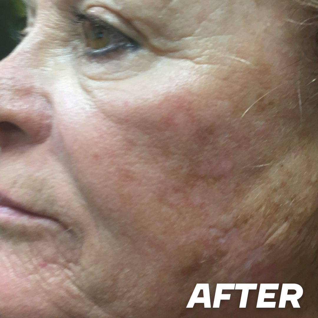 Joan after treatment