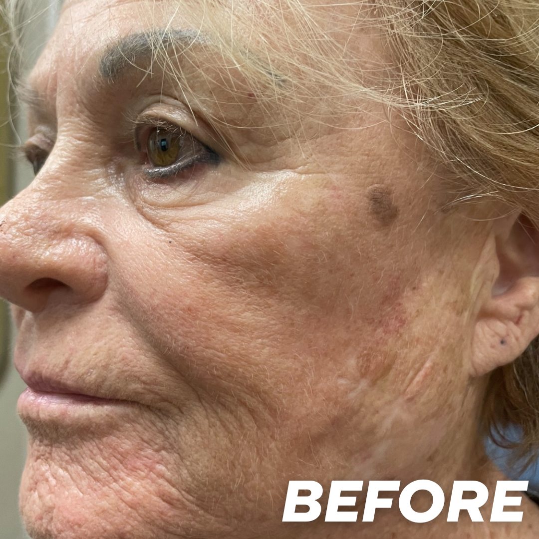 Joan before treatment