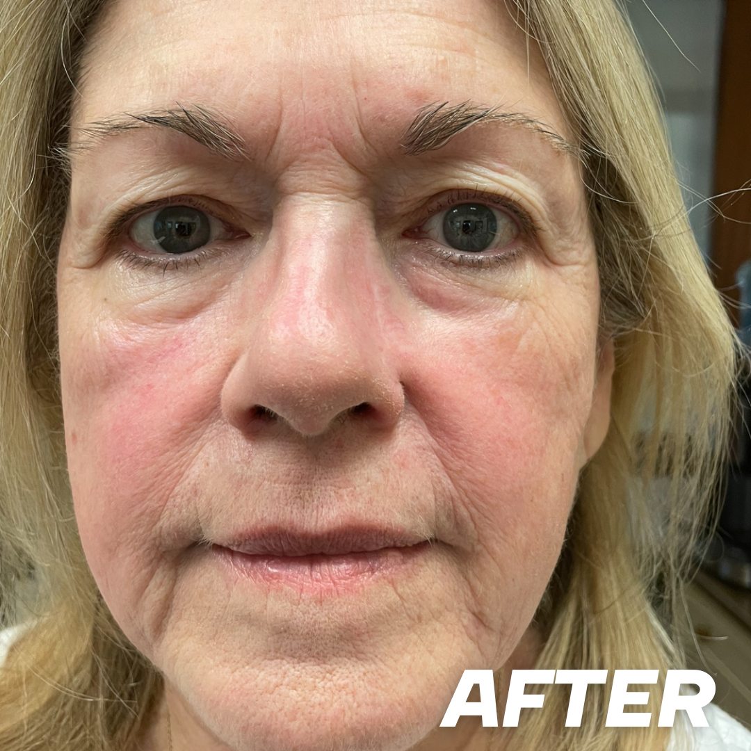 Julie after treatment
