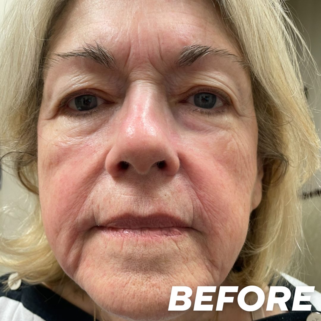 Julie before treatment