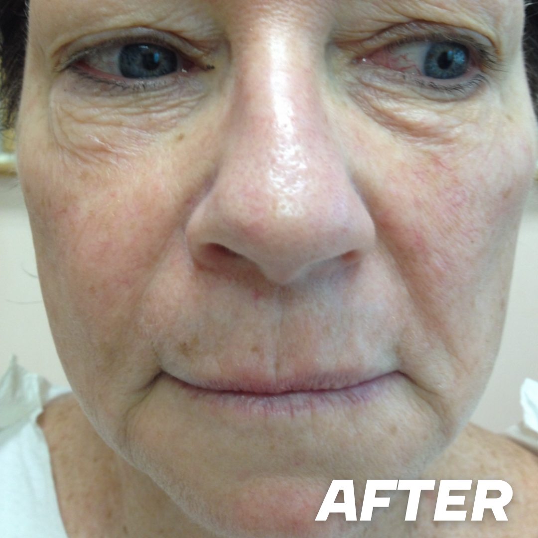 Lynn after treatment