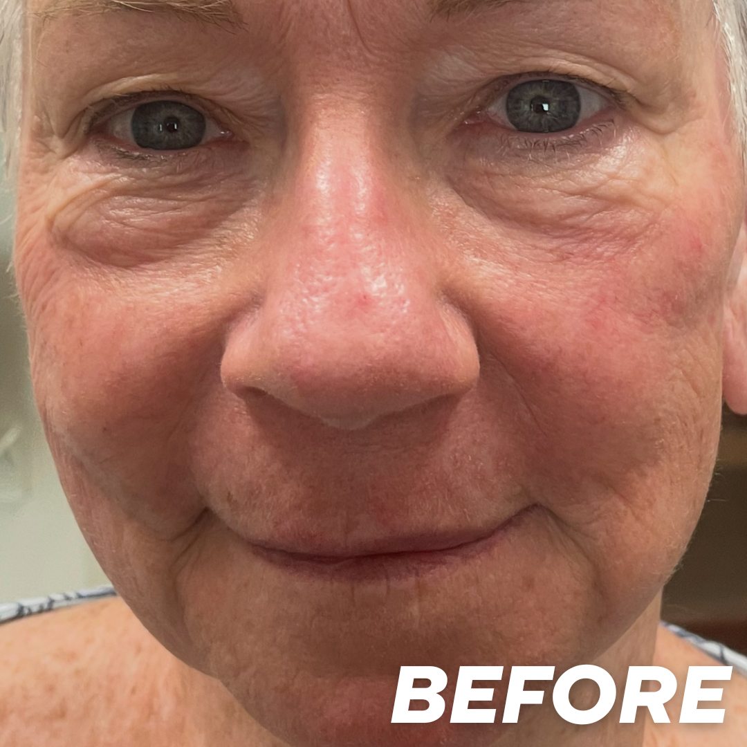 Lynn before treatment