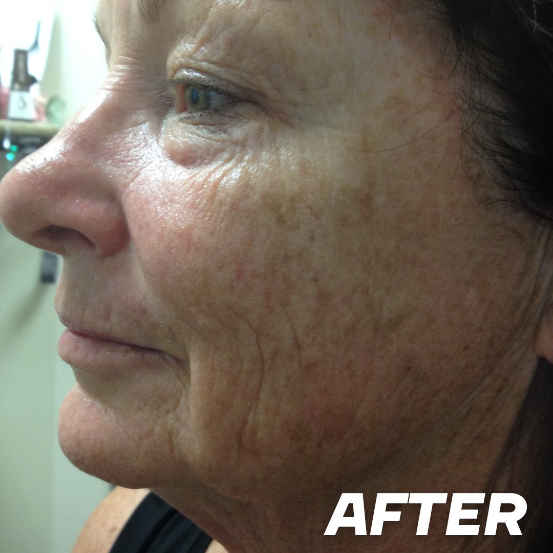 Maryann after treatment