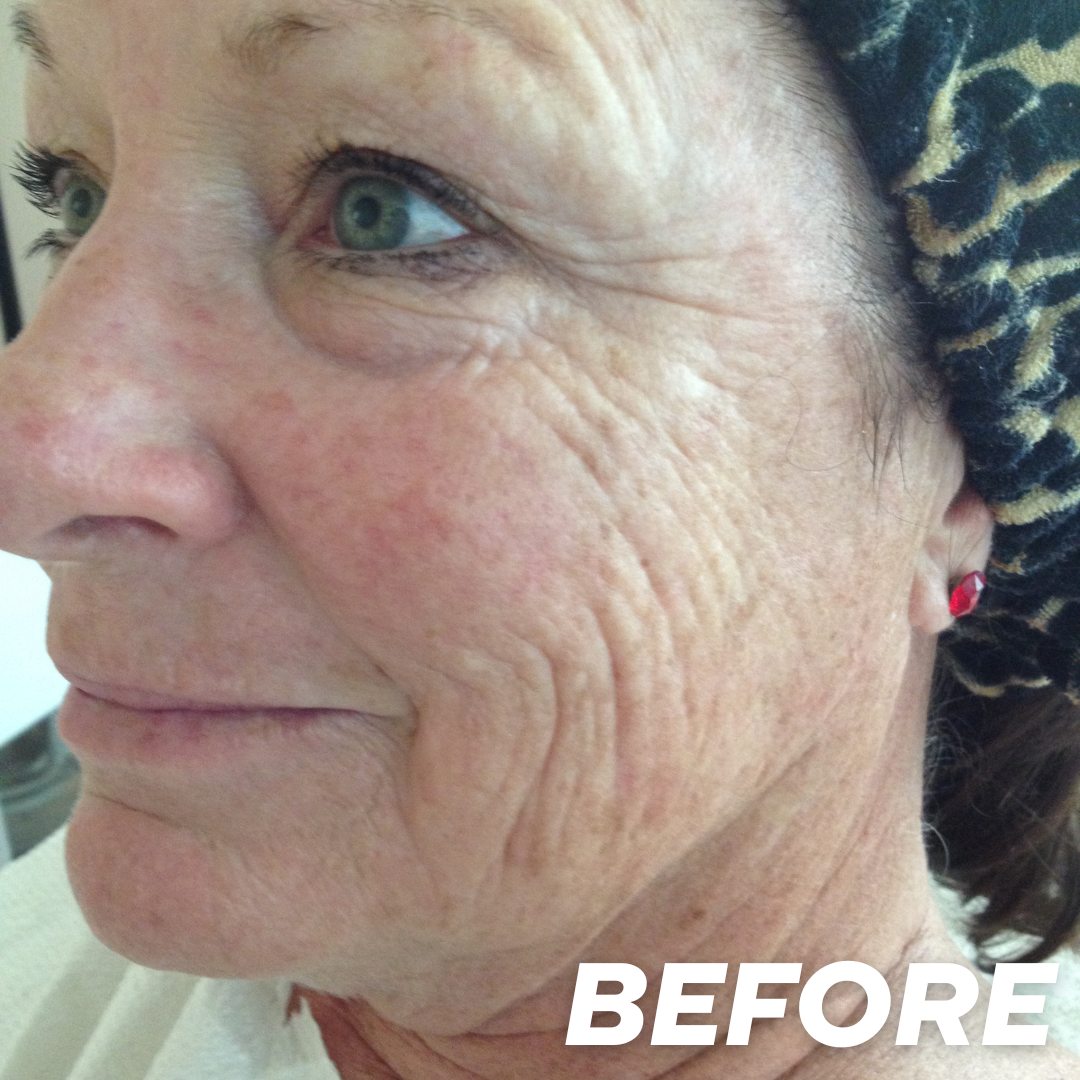 Maryann before treatment