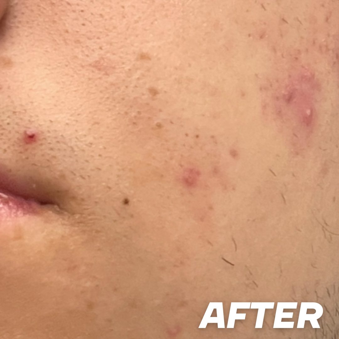 Teen after treatment