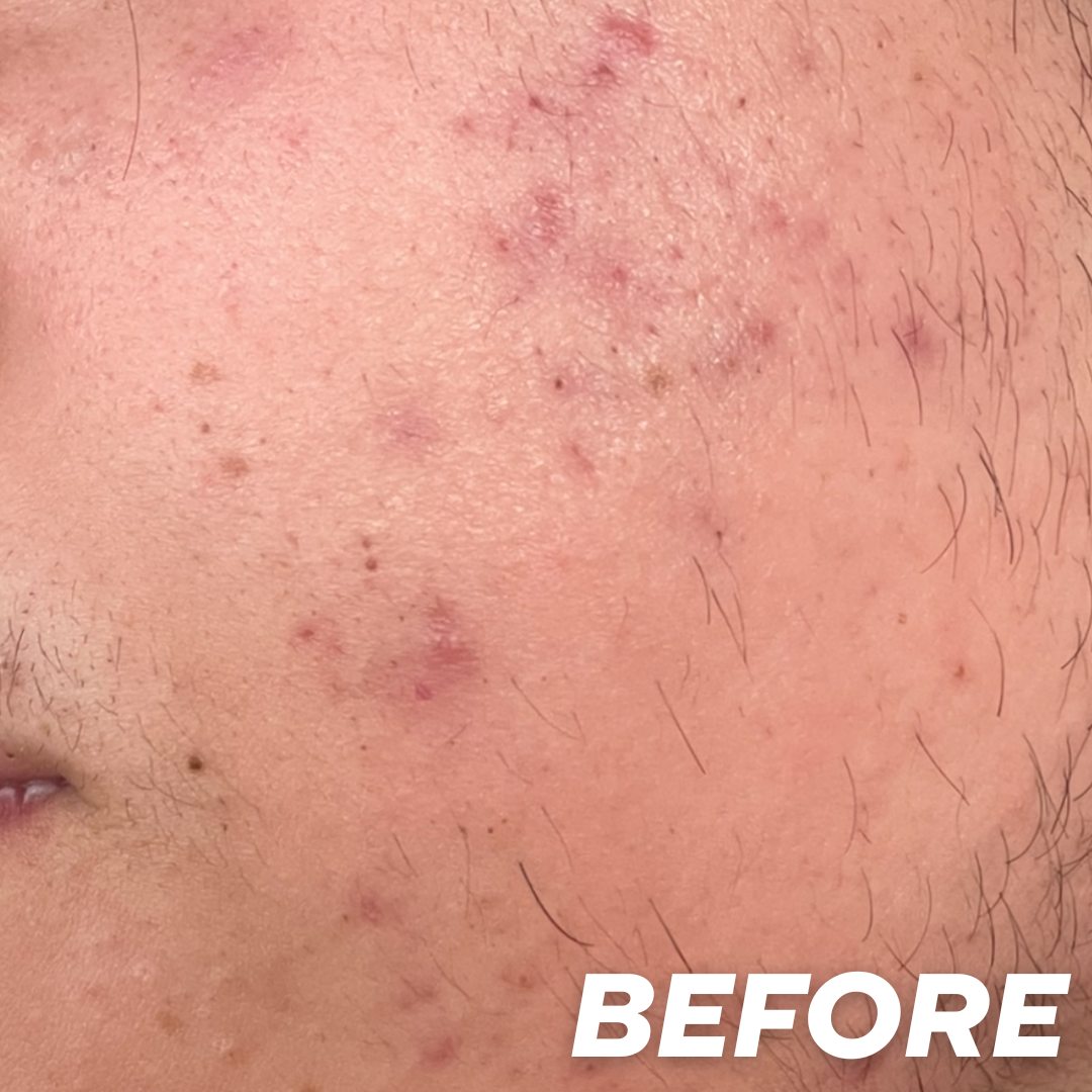 Teen before treatment
