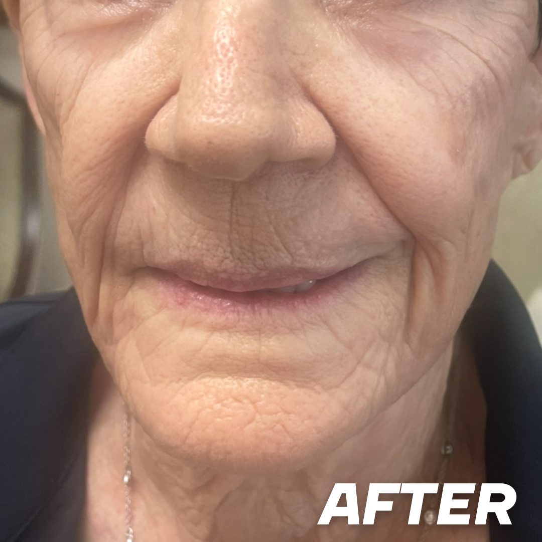 Vita after treatment