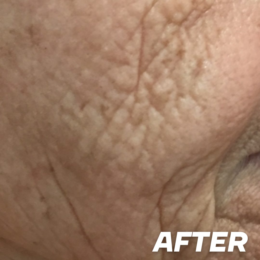 Wrinkles after treatment