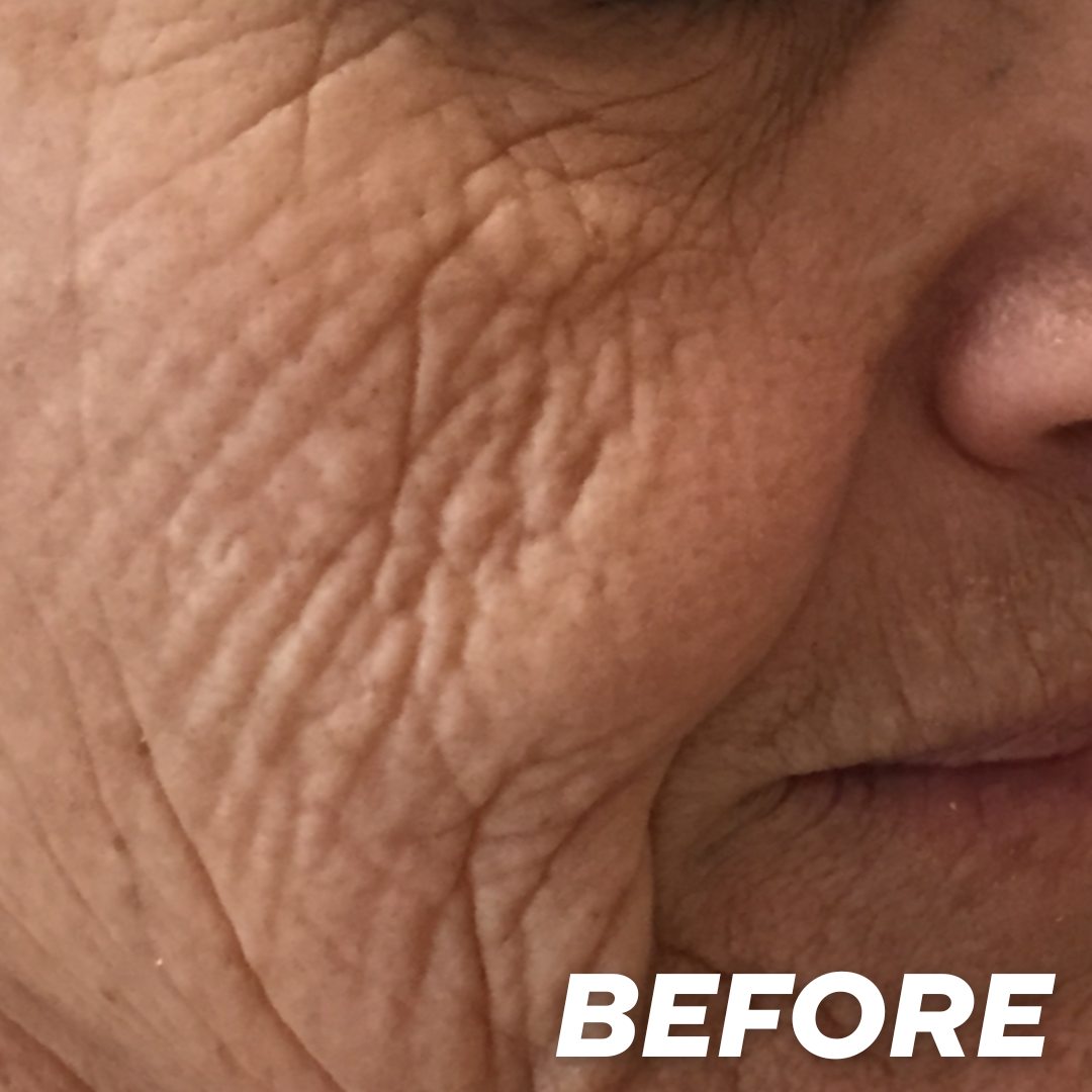 Wrinkles before treatment